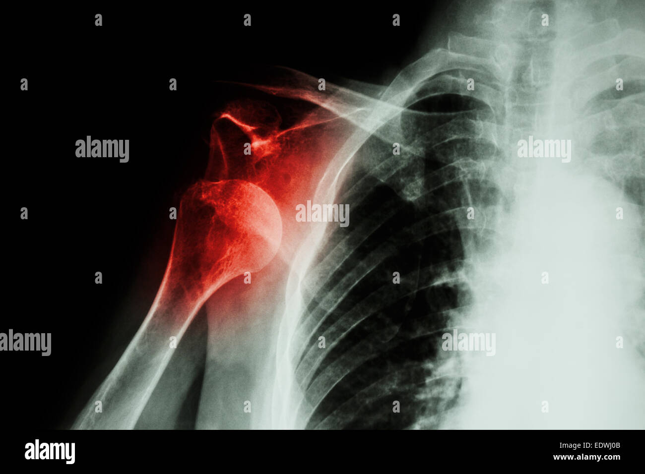 X-ray dislocación de hombro anterior Foto de stock