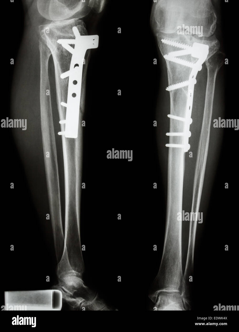 Fractura del hueso de la pierna (tibia). Fue operado y fija interna de chapa&tornillo Foto de stock