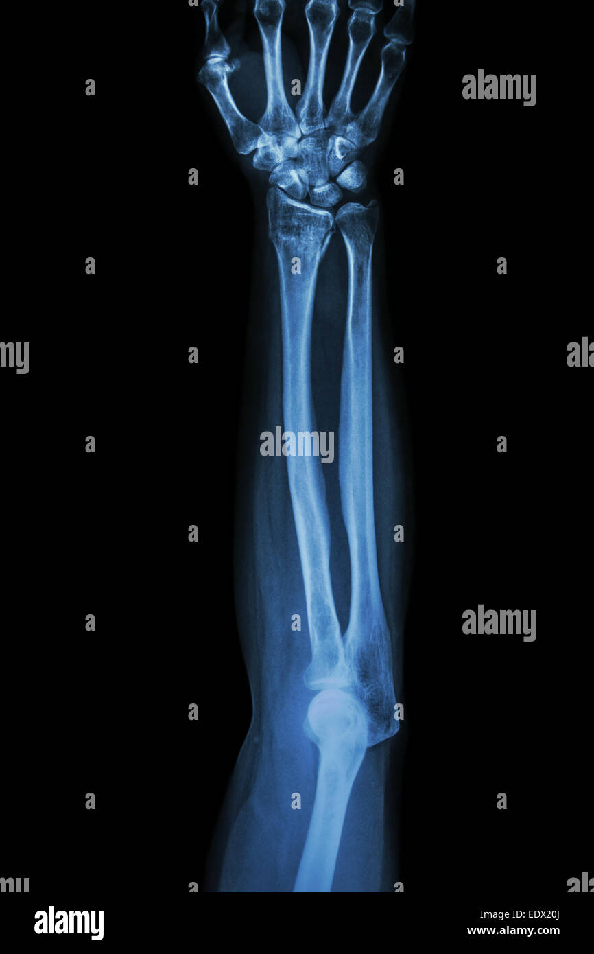 Fracturas distales del radio (muñeca) ,(Colles' fractura ósea) Foto de stock