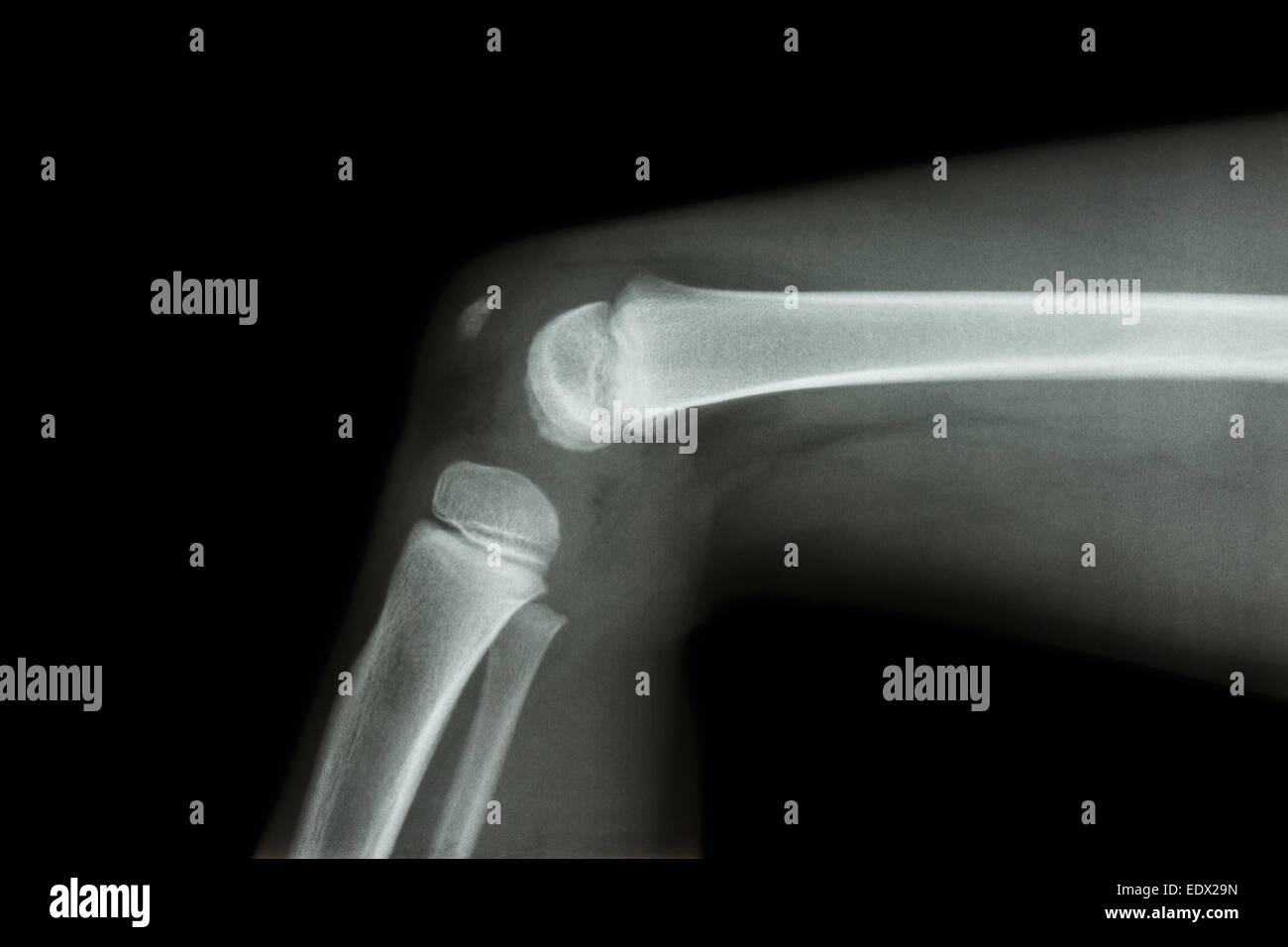 Película de rayos X lateral de la rodilla del niño Foto de stock