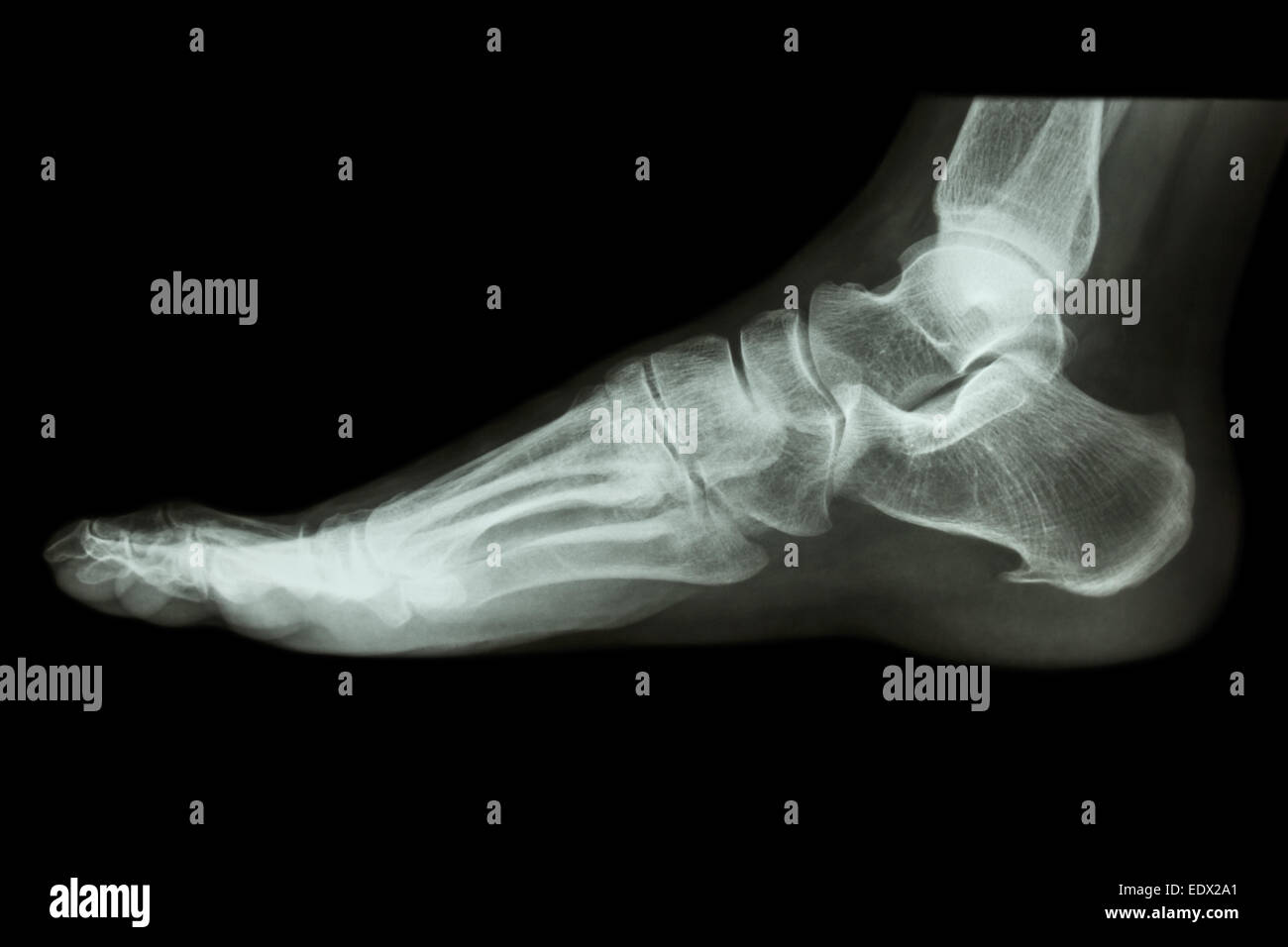 Radiografía lateral del pie humano normal Foto de stock