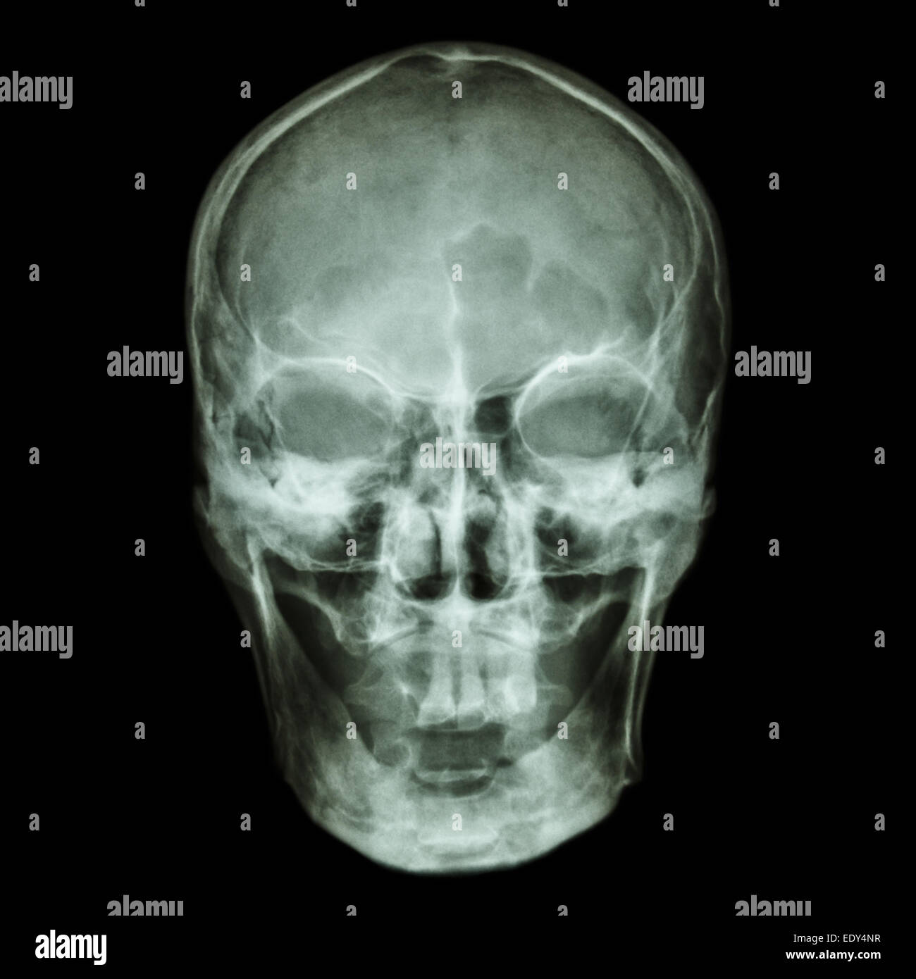 Radiografía de cráneo (asiática) Foto de stock