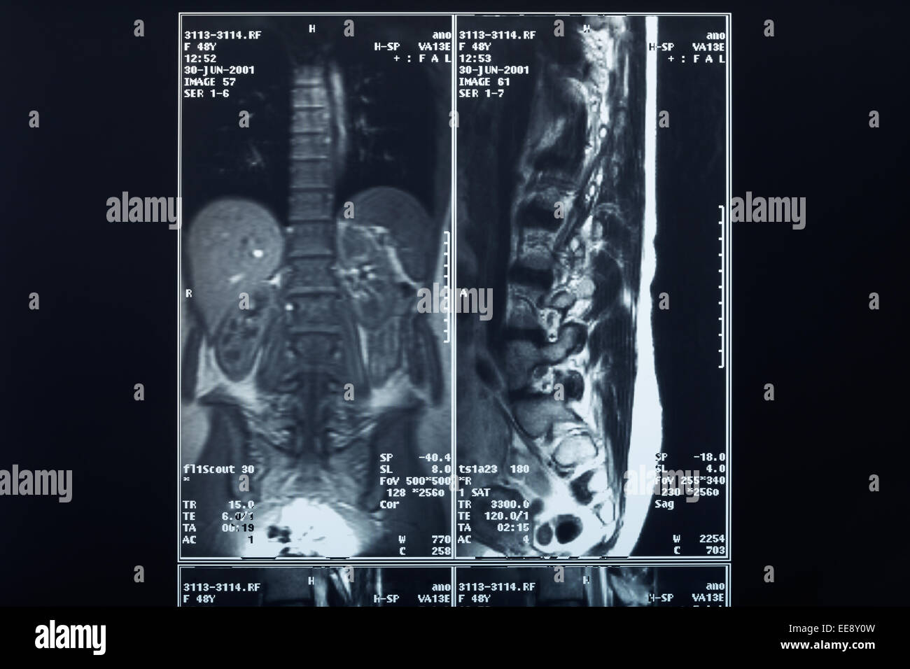 Radiografía de la columna vertebral de rayos X Foto de stock