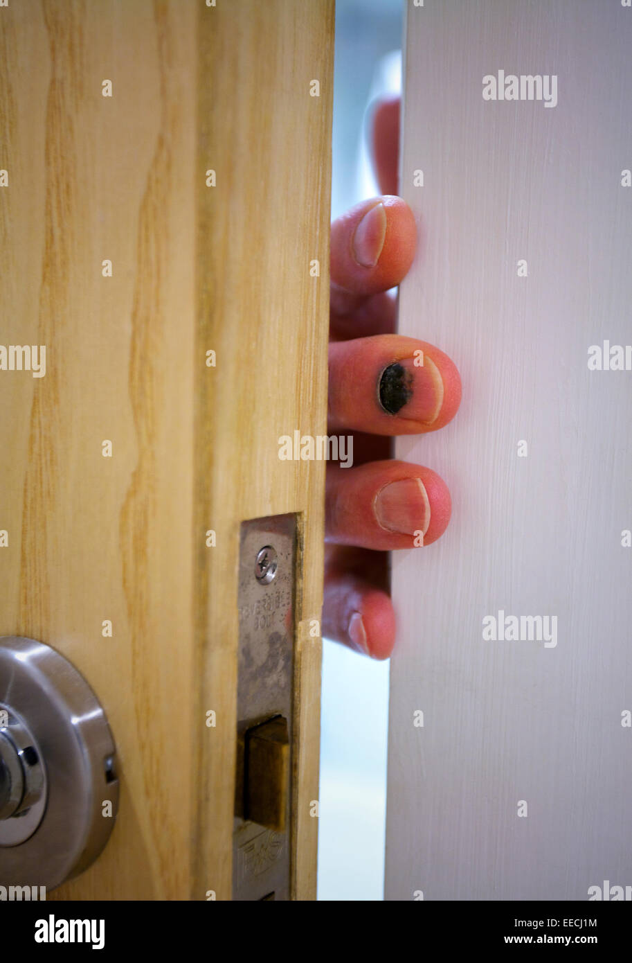 Para ilustrar cómo la uña del dedo se convirtió en hematomas cuando una