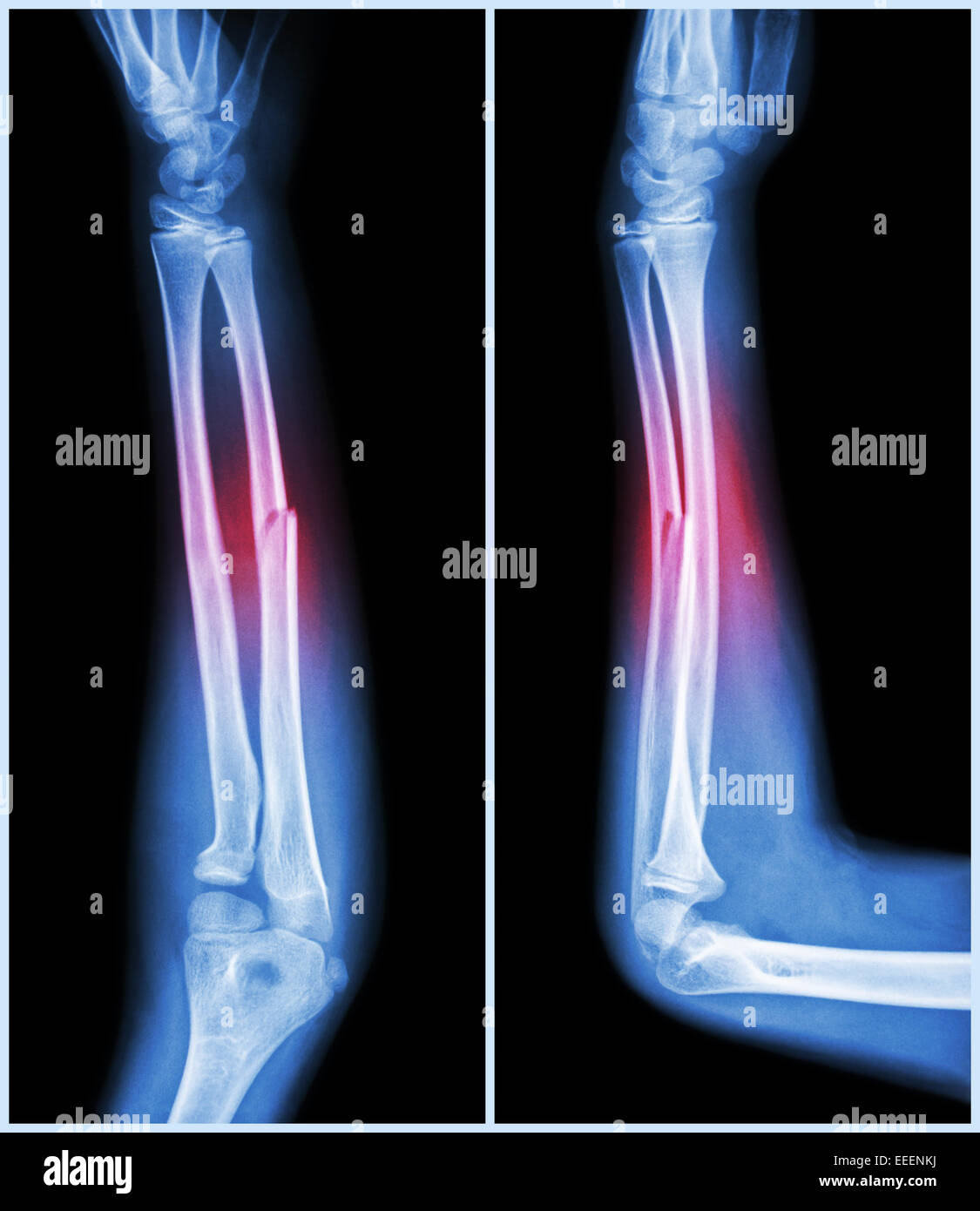 Eje De Fractura Del Hueso Cubital El Hueso Del Antebrazo Vista Frontal Y Lateral Fotografia De Stock Alamy