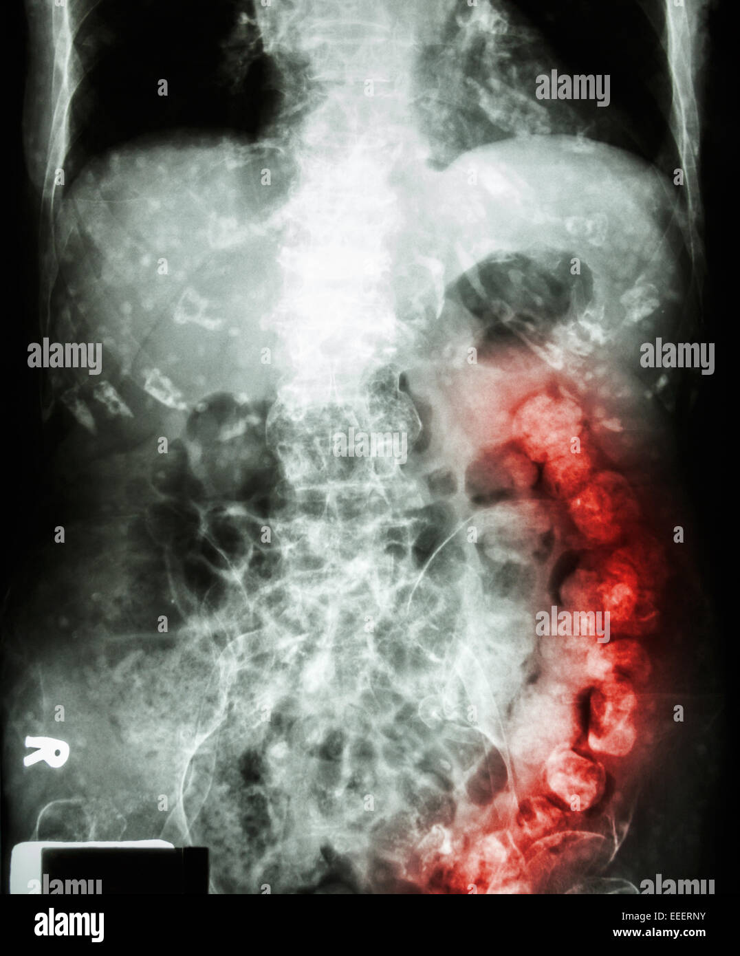 Estreñimiento ' ' ( rayos X del abdomen del hombre viejo : un montón de excremento en el intestino grueso y calcificada en costilla ) Foto de stock