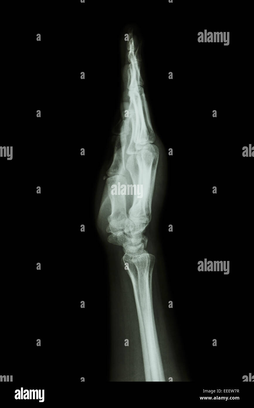 X-ray de mano y antebrazo lateral AP ( ) ( ) Vista lateral Foto de stock
