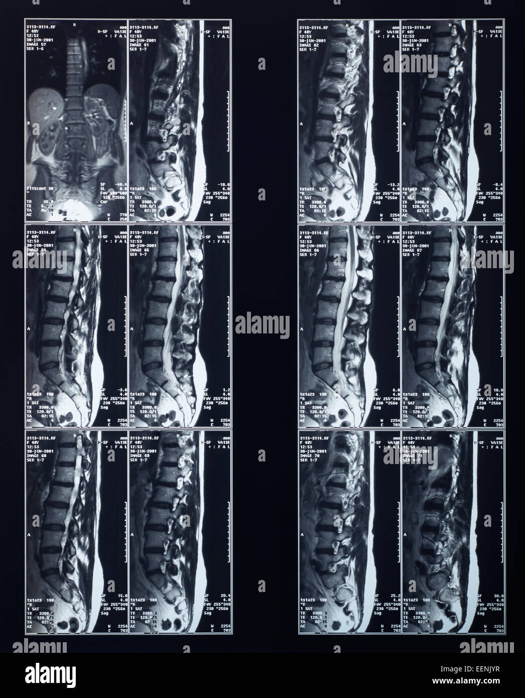 Radiografía de la columna vertebral de rayos X Foto de stock