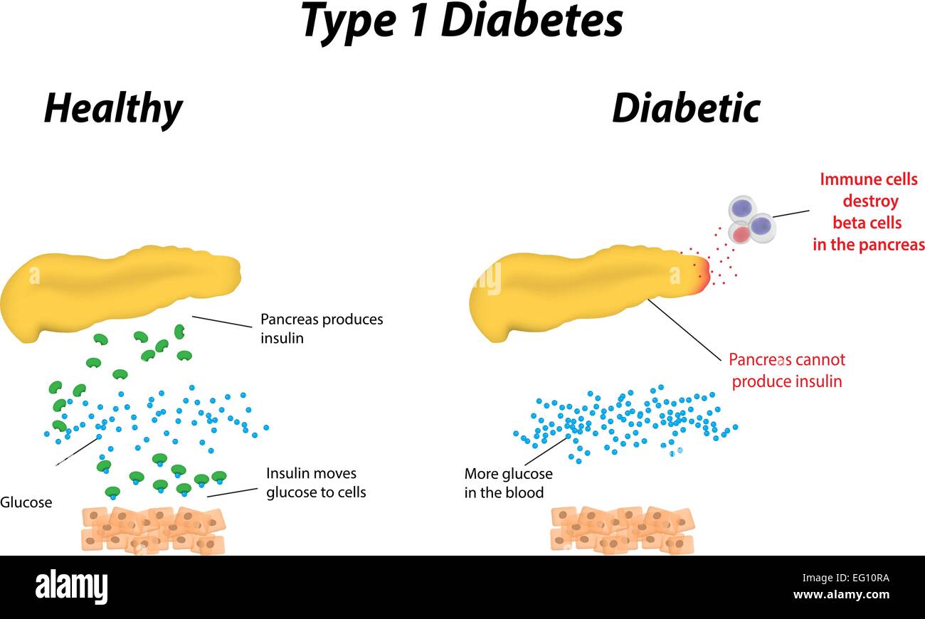 Diabetes tipo 1 Ilustración del Vector