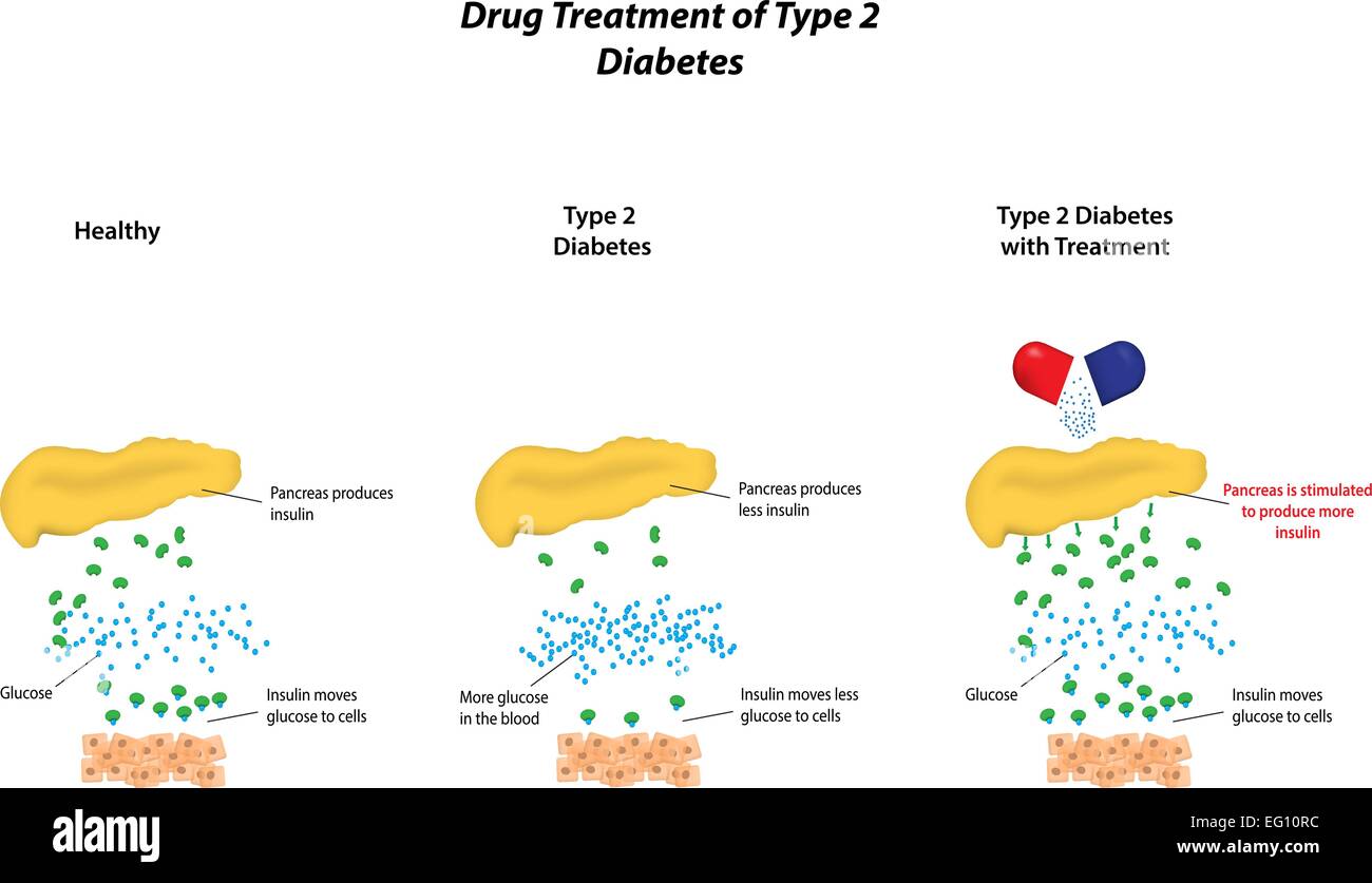 El tratamiento farmacológico de la diabetes tipo 2 Ilustración del Vector