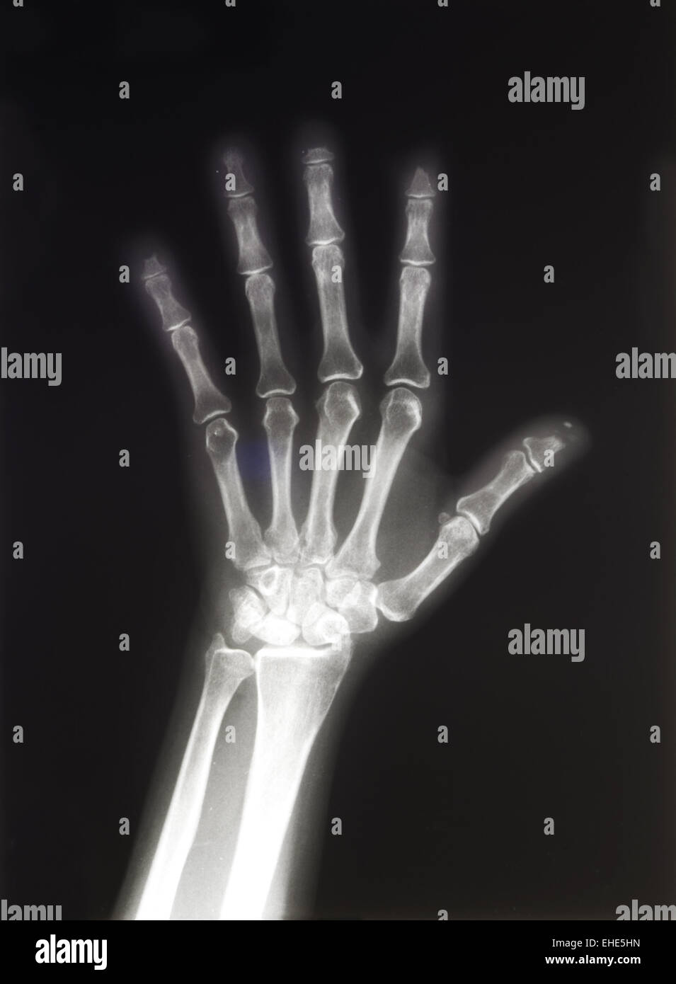 Radiografía de las manos Foto de stock