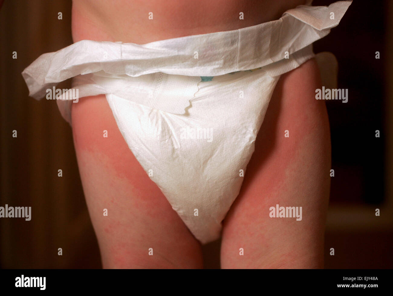 de reacción de alergia, un niño sufre reacción alérgica después de comer una tuerca resultando en una erupción roja y la hinchazón Fotografía de stock - Alamy