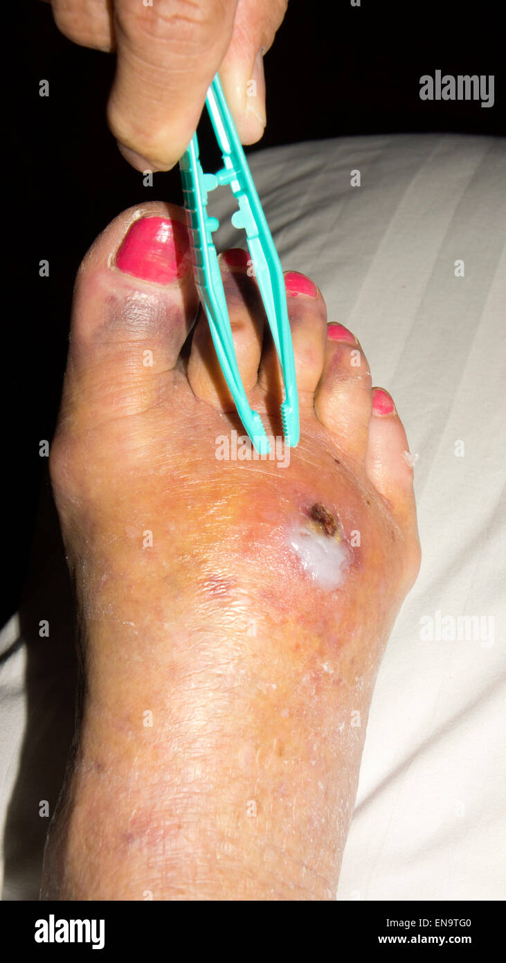 Un pie lesionado con hematoma, infección con hinchazón y hematomas Foto de stock