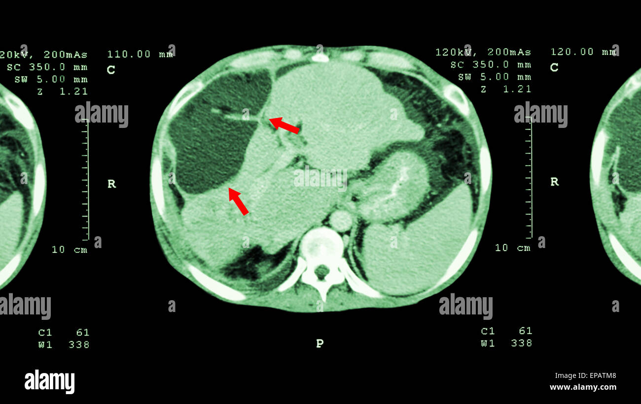 Tc del abdomen superior : mostrar masa anormal en el hígado ( cáncer de hígado ) Foto de stock