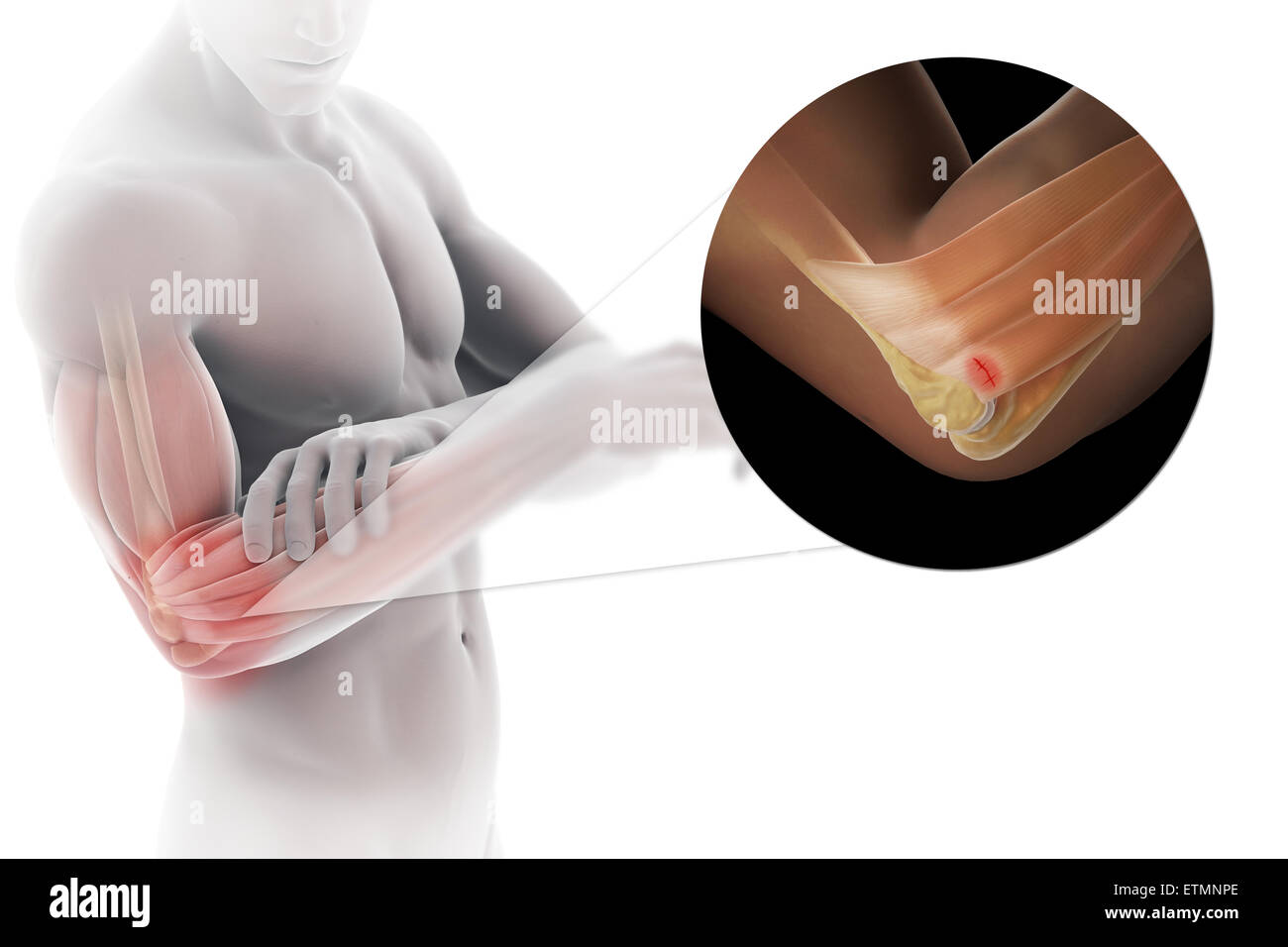 Ilustración del brazo con piel transparente para mostrar lesiones de tendón epicóndilo lateral, conocido como epicondilitis lateral o codo de tenista. Foto de stock