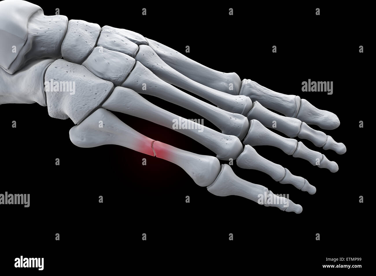 Ilustración que muestra los huesos del pie con una rotura en un metatarsiano resaltada. Foto de stock