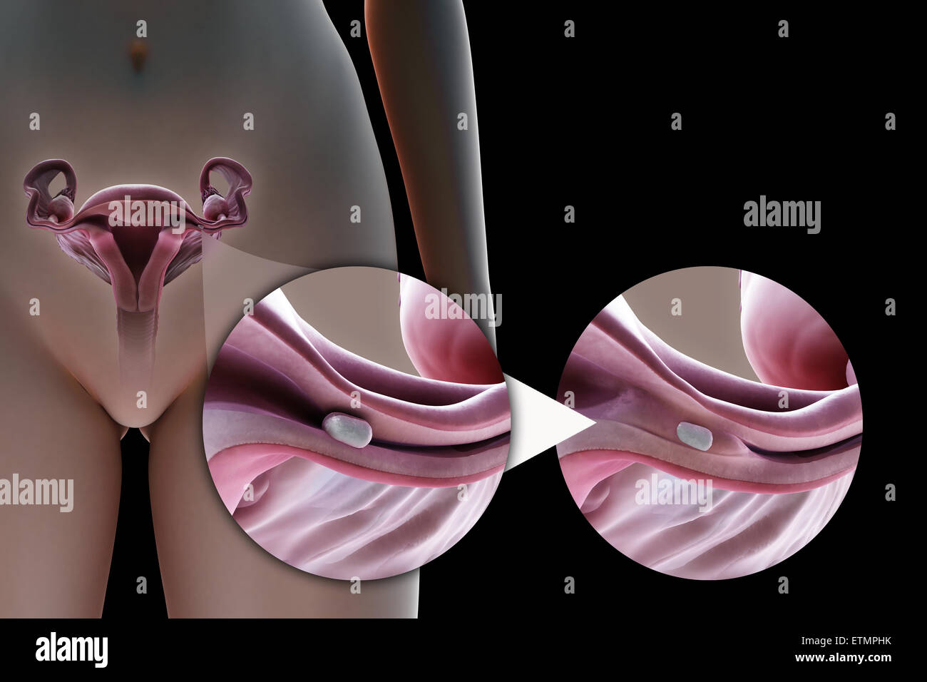 Ilustración que muestra la ligadura de trompas de la trompa de Falopio por el método de un implante de silicona, que se utiliza para bloquear el tubo por el crecimiento de tejido cicatrizal y prevenir la fertilización. Foto de stock