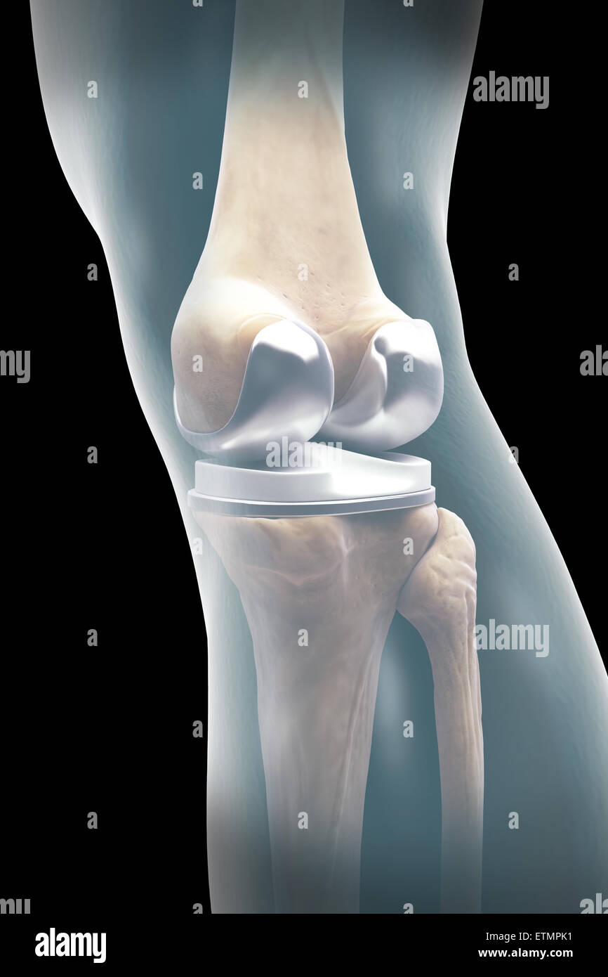 Ilustración mostrando una artroplastia de rodilla visibles en la pierna. Foto de stock