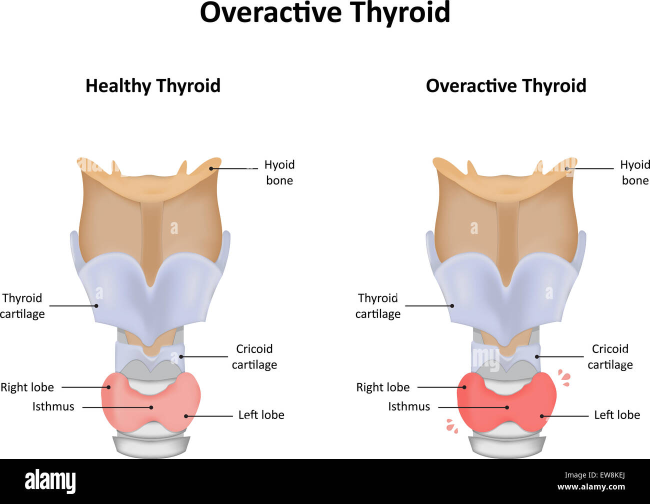 Hipertiroidismo fotografías e imágenes de alta resolución Alamy