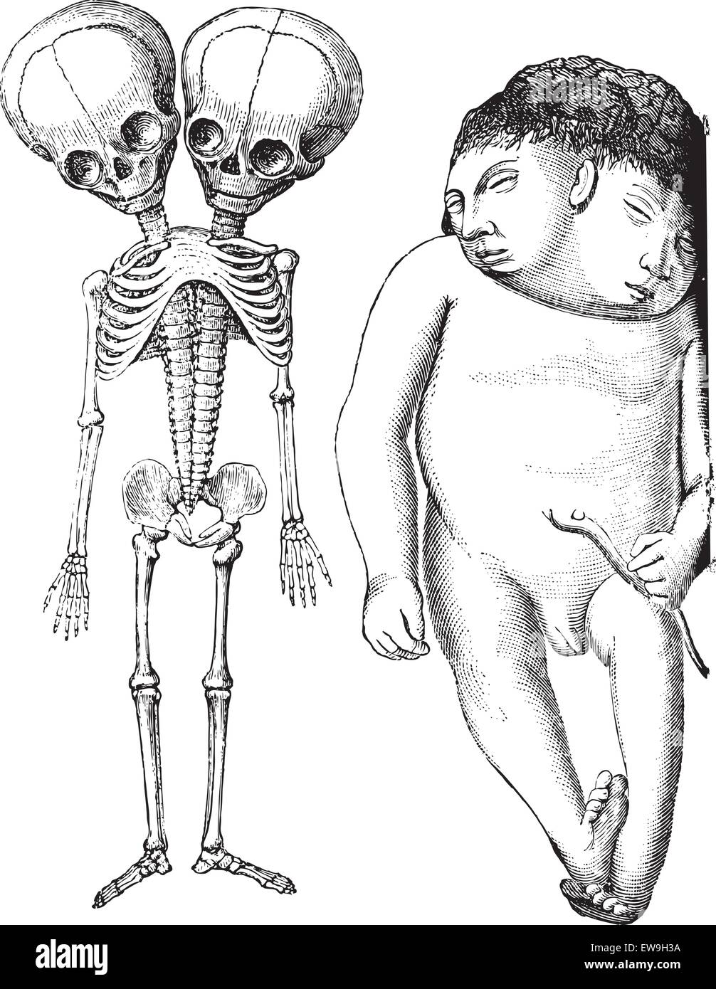 Fig. 174. El esqueleto del monstruo de dos cabezas derodyme. (Musee contractura) Fig. 175. Iniodyne monstruo de dos cabezas, vintage mal grabado Ilustración del Vector
