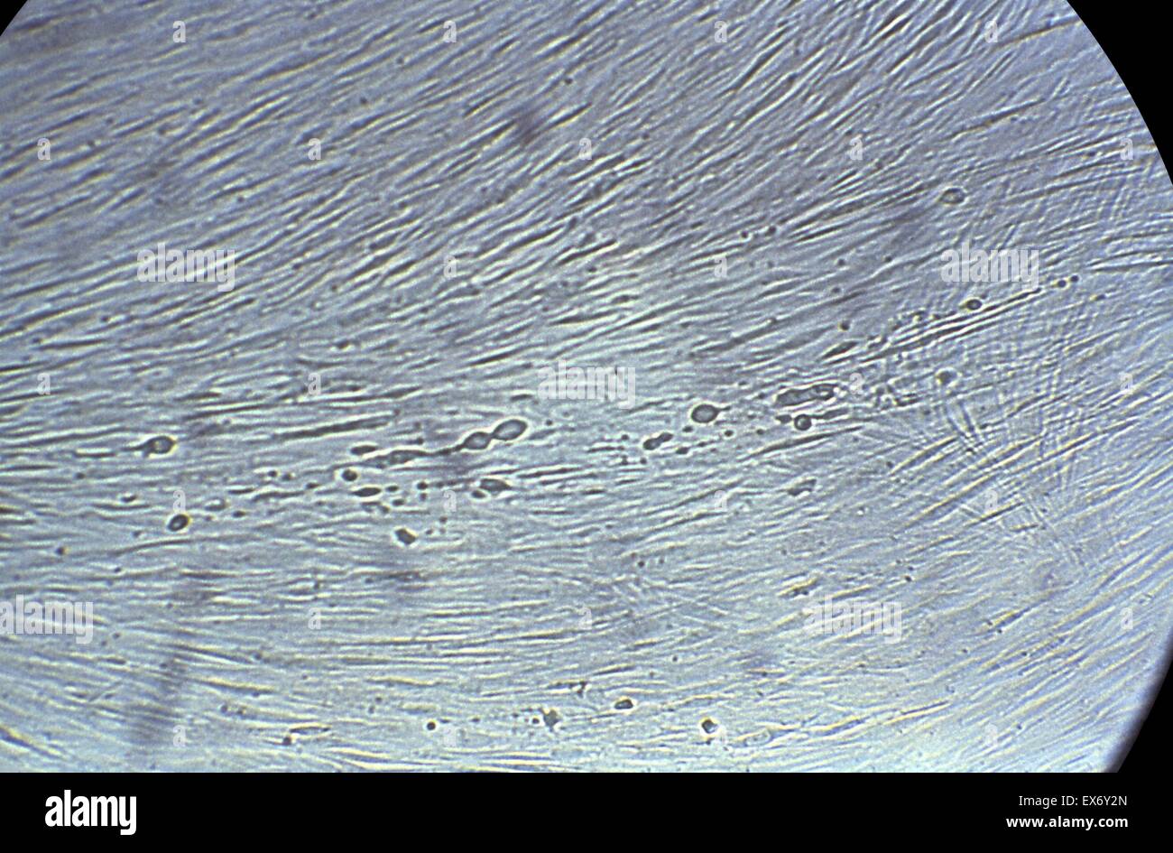 Microfotografía mostrando efectos histopatológicas del virus del herpes simple en una cultura de células de fibroblastos de pulmón embrionario humano. Esto se denomina una etapa temprana de la infección. El herpes genital es una enfermedad de transmisión sexual (ETS) causada por el herpes simpl Foto de stock