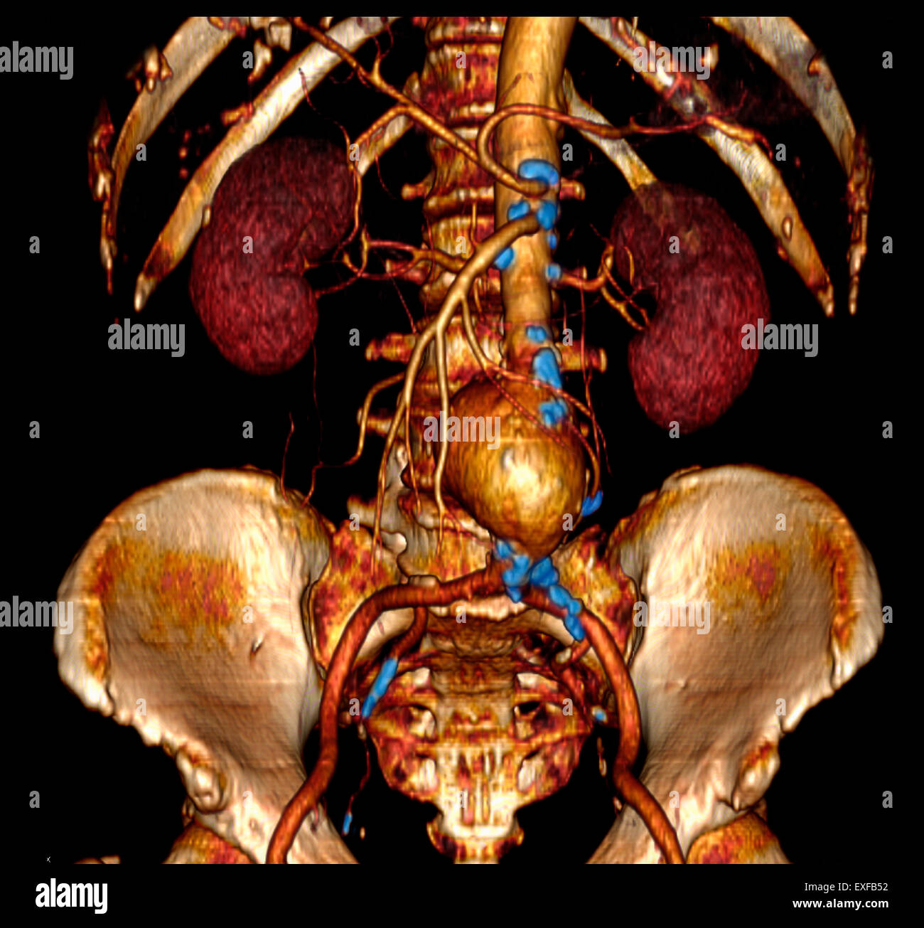 El Aneurisma De Aorta Abdominal Mejora Al Inhibir Una Protena