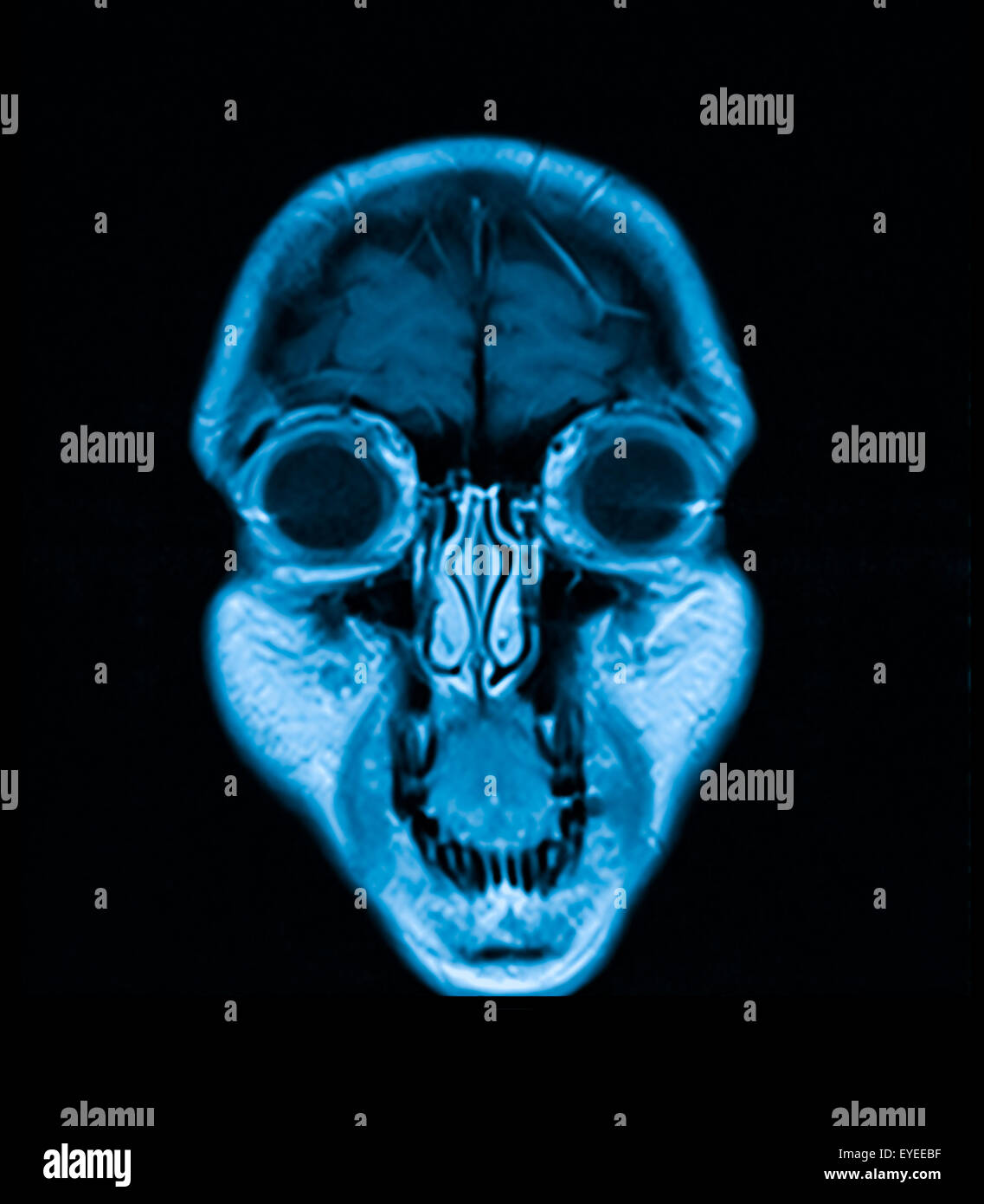 Imagen de resonancia magnética de la cabeza IRM de la cabeza scan Foto de stock