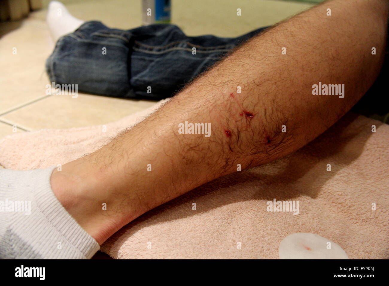 Mordida de perro en la pierna fotografías e imágenes de alta resolución -  Alamy