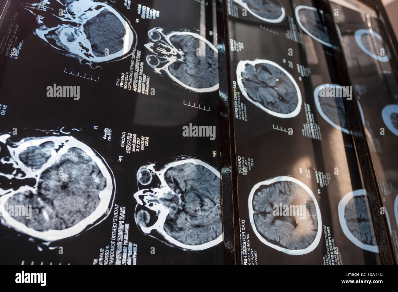 Multi radiografía del cerebro. Guadalajara, Jalisco. México Fotografía