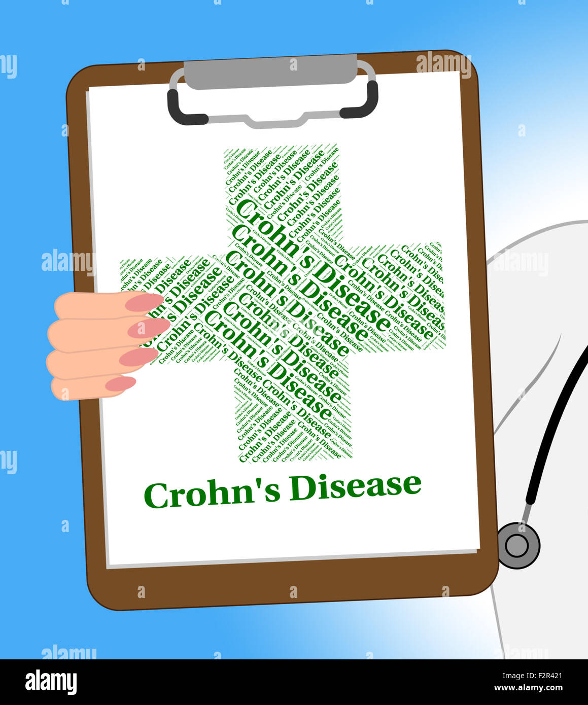 Enfermedad de Crohn en representación de enteritis regional y Crohn