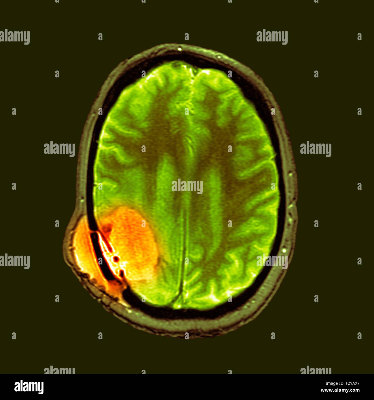 Despues De La Cirugia Del Cancer De Cerebro Color De Imagenes De Resonancia Magnetica Mri Por Sus Siglas En Ingles De Una Seccion A Traves De La Cabeza De Un Hombre De