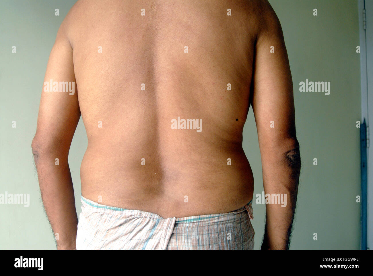 Grasa obesos voluminoso cuerpo carnoso de un hombre la edad en torno a 50 ; La India Foto de stock
