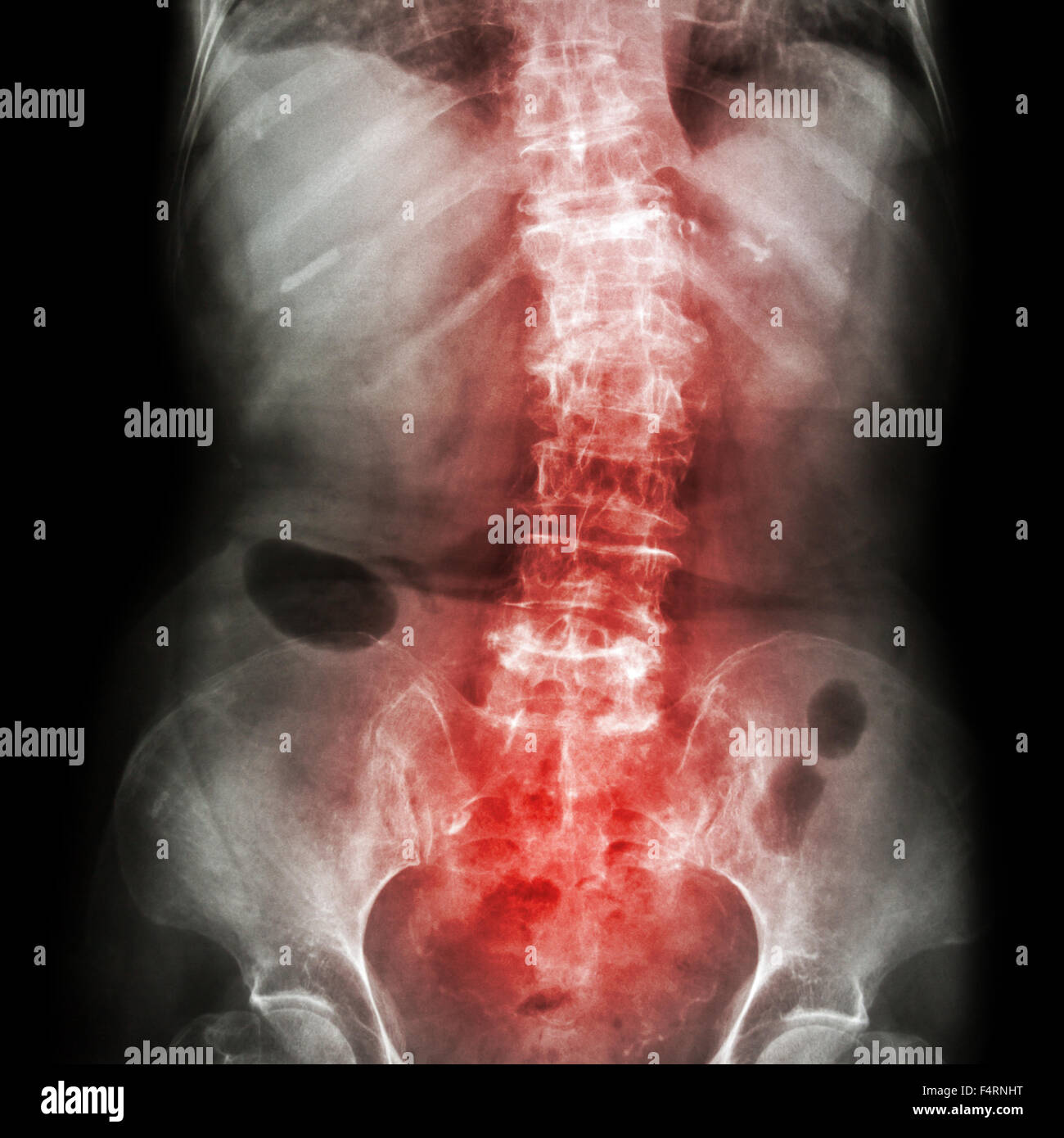 Película escoliosis radiografía AP de la columna lumbar:…