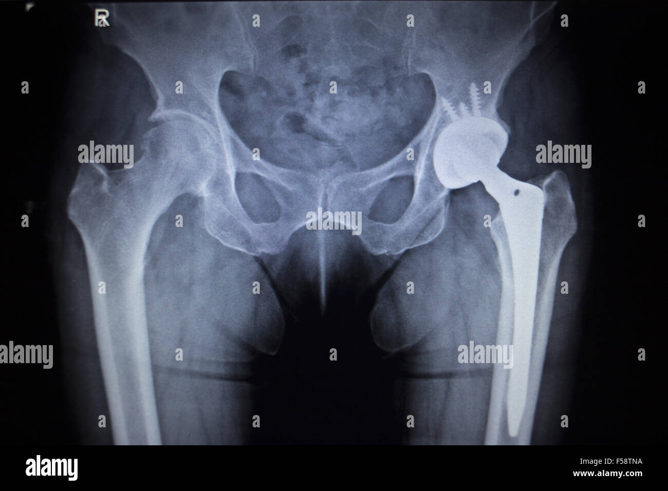 Escaneado de imagen de rayos X de las articulaciones de la cadera con el  reemplazo de la articulación de cadera de implantes ortopédicos y los  tornillos de cabeza en el esqueleto humano