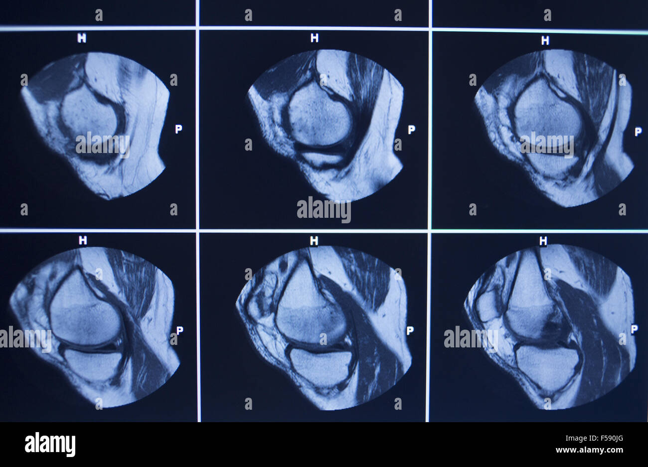 Resonancia magnética nuclear resonancia magnética magentic digitalizar los  resultados de la prueba de la rodilla lesiones de menisco foto Fotografía  de stock - Alamy