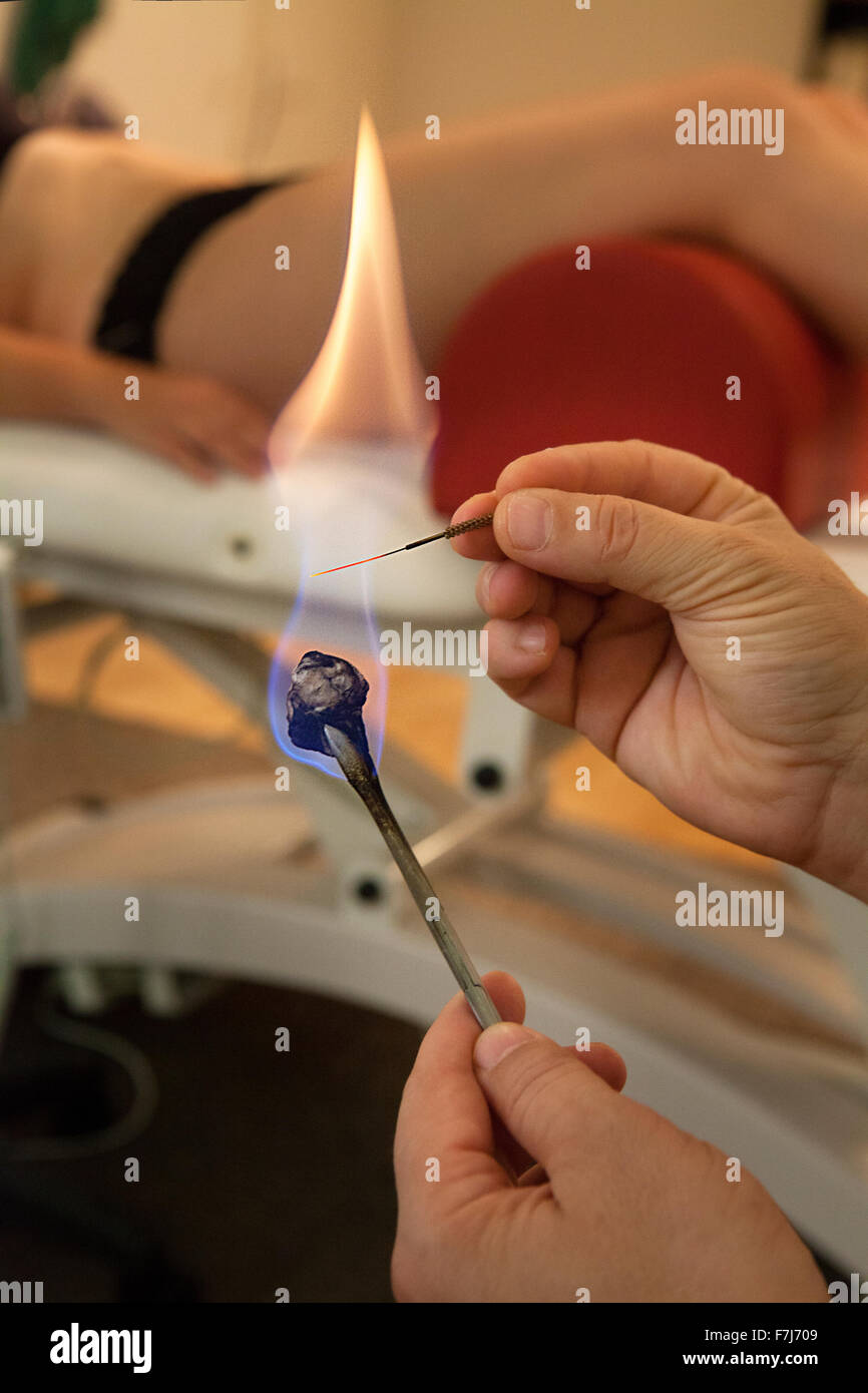 Medicina tradicional china tcm 1 5 agujas de acupuntura fotografías e  imágenes de alta resolución - Alamy