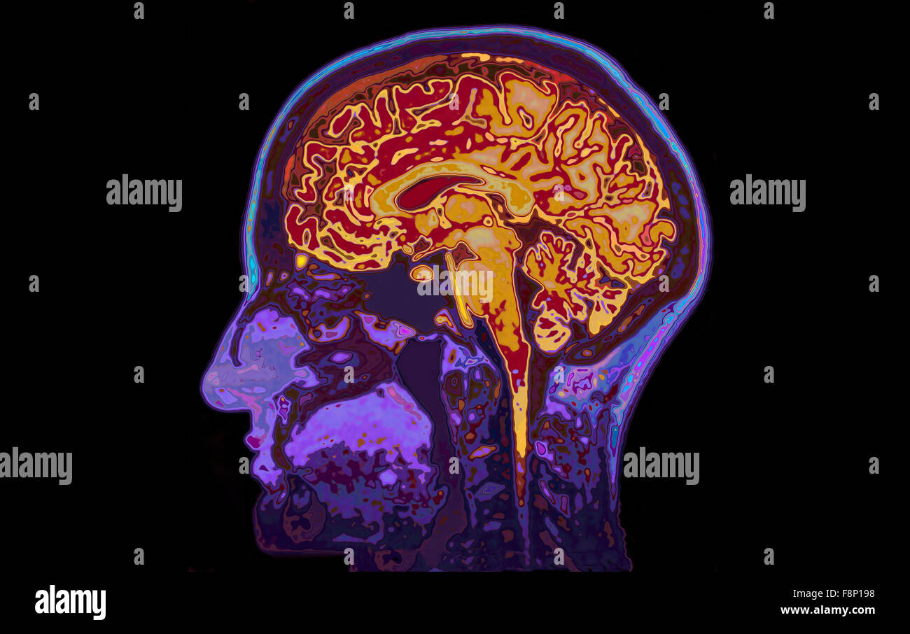 Imágenes de resonancia magnética de la cabeza que muestra el cerebro Foto de stock