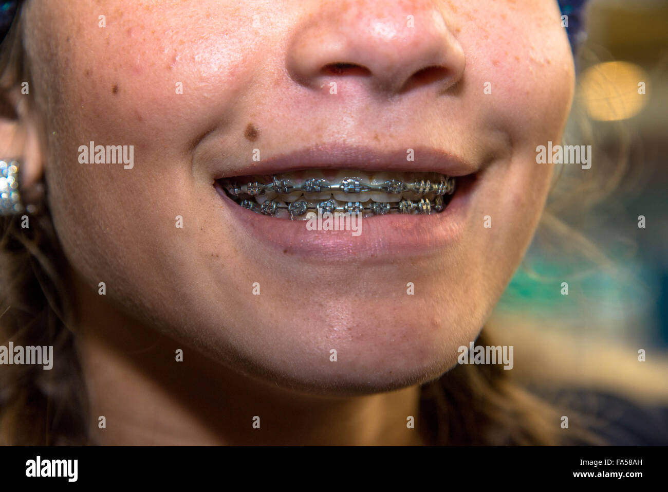 Corrección de dientes fotografías e imágenes de alta resolución - Alamy