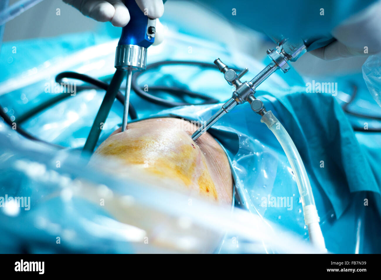 Artroscopia de rodilla operación de cirugía ortopédica en el hospital  quirófano foto mostrando cirujano con artroscopia cámara y sonda Fotografía  de stock - Alamy