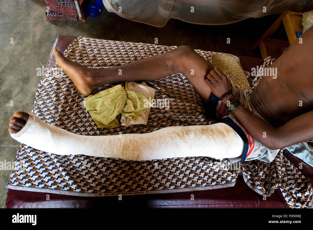 Un joven pierna operada se está recuperando EN UNA DE LAS SALAS DEL CENTRO DE REHABILITACIÓN DE Don Orione en el norte de Togo Foto de stock