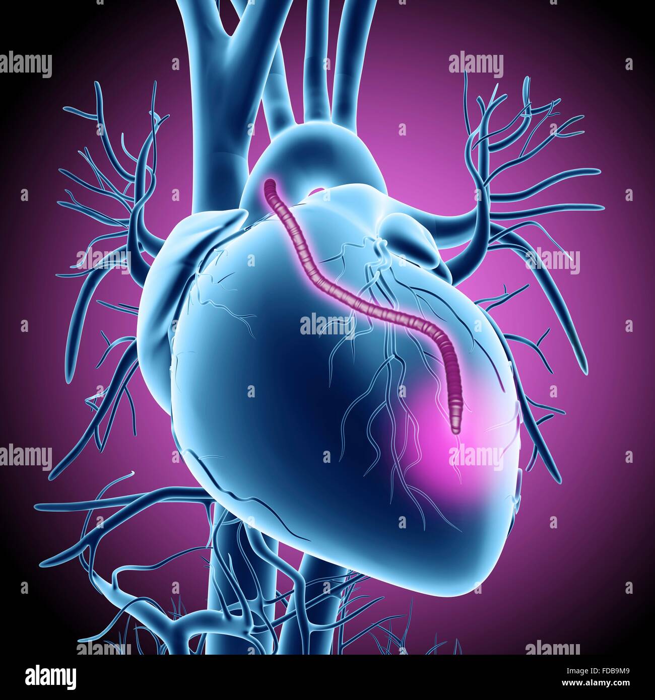 Injerto de bypass del corazón. Equipo ilustraciones de un corazón que ha tenido una obstrucción de las arterias coronarias tratada mediante injerto de derivación de la arteria coronaria (CABG) cirugía. Las arterias coronarias son los pequeños vasos sanguíneos visto corriendo en la superficie externa del corazón. El suministro de sangre oxigenada para mantener el músculo del corazón bombeando, y una obstrucción puede causar un ataque cardíaco fatal. La solución es la cosecha de arterias en otras partes del cuerpo y utilizarlos para evitar el bloqueo. Un injerto es visto corriendo de la aorta, la principal arteria del cuerpo, la espalda a las arterias coronarias. Foto de stock