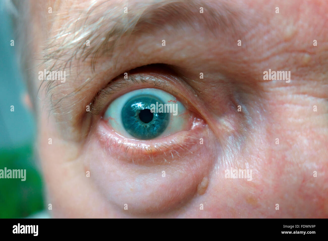 Un globo ocular y ojo azul en la cara de un hombre Foto de stock