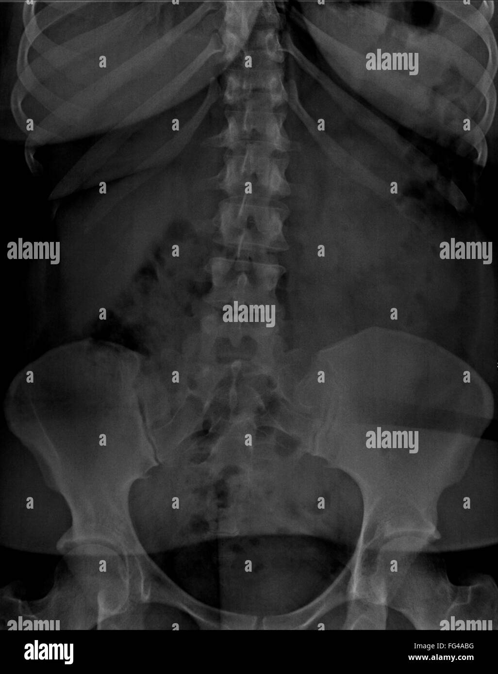 Rx abdomen con piercing Foto de stock