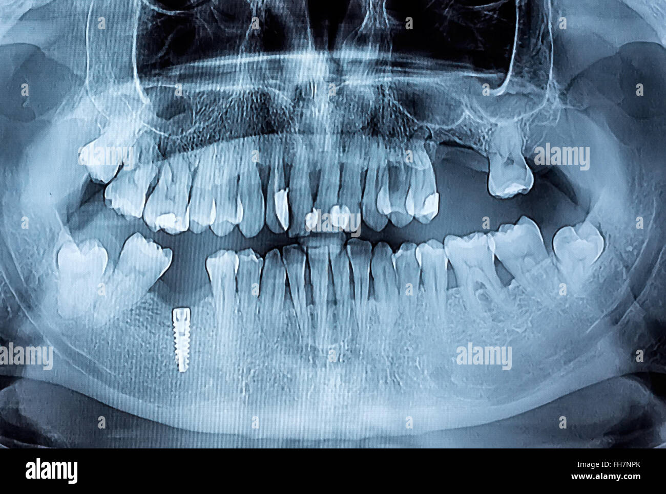 Radiografía dental con periodontitis problemas, dientes cariados y el