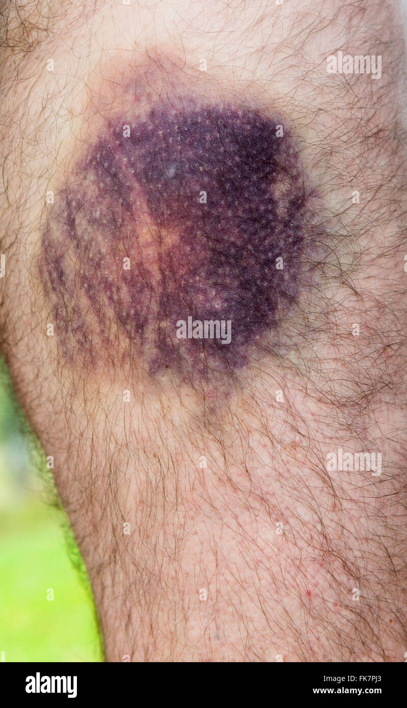 Hematoma pierna fotografías e imágenes de alta resolución - Alamy