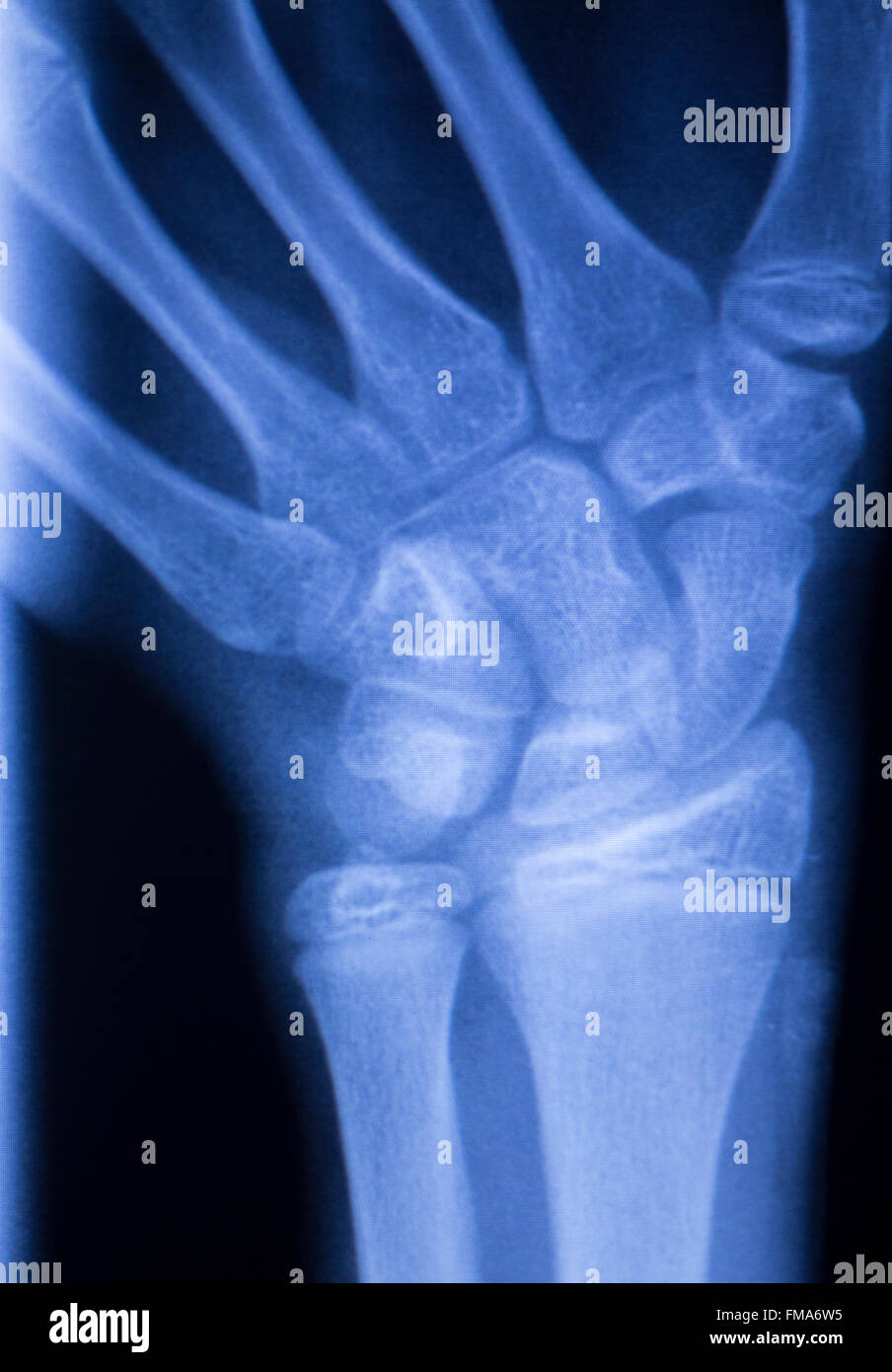 La mano, dedos pulgar y muñeca lesiones traumatología ortopédica prueba de rayos  x médicos Escanear imagen Fotografía de stock - Alamy