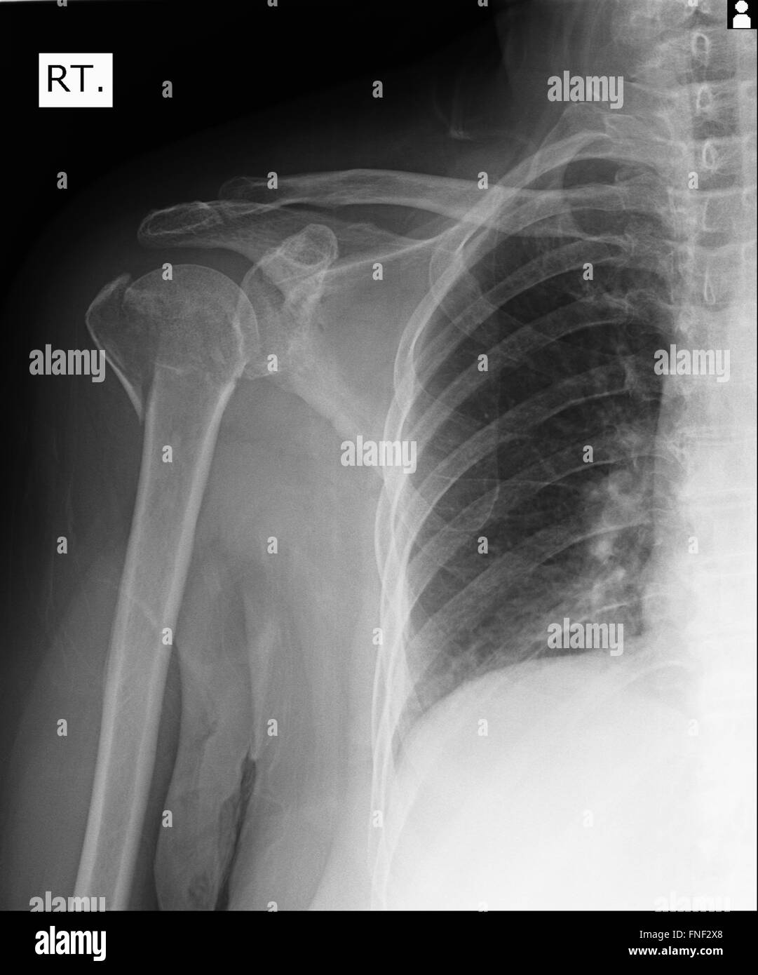 Radiografía de hombro humano Foto de stock