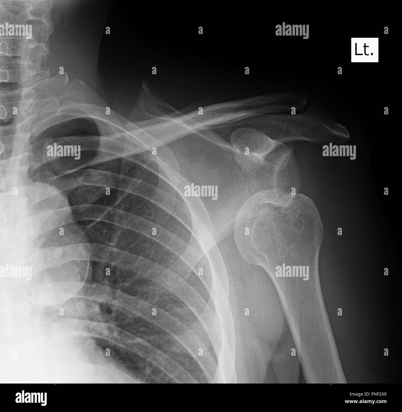 Radiografía de hombro humano Foto de stock