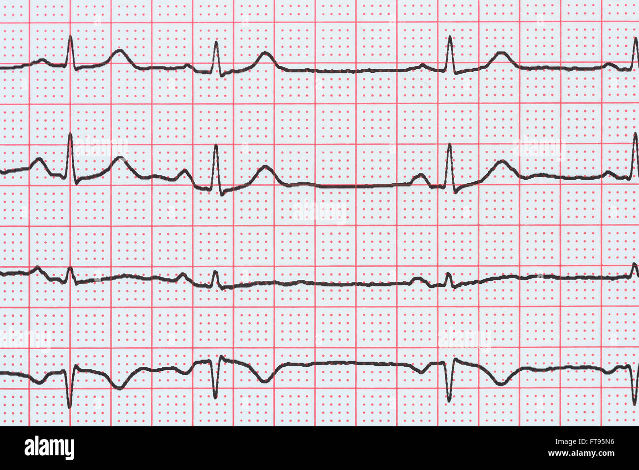 Ritmo cardíaco sinusal en el electrocardiograma registro mostrando papel normal de la onda P, PR Ritmo cardíaco sinusal en el electrocardiograma registro mostrando papel normal de la onda P, PR