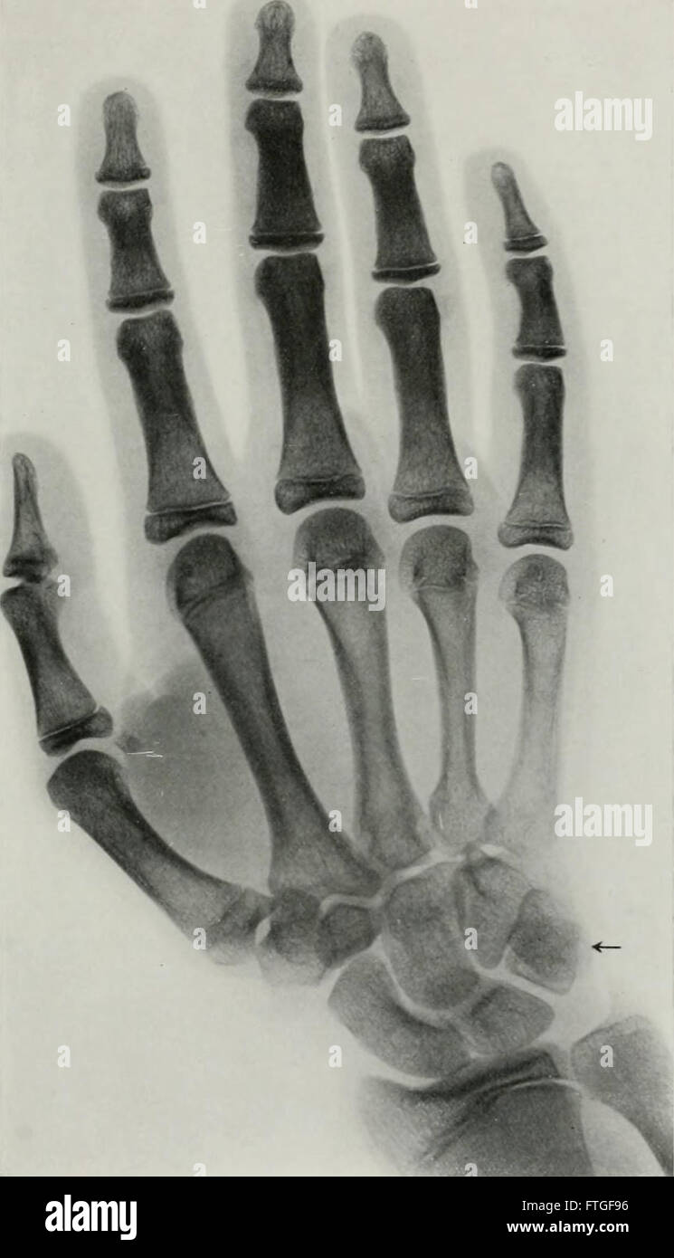 Viviendo la anatomía y de la patología; el diagnóstico de enfermedades en los primeros años de vida por el método Roentgen (1910) Foto de stock